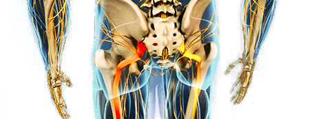 sciatica pain relief